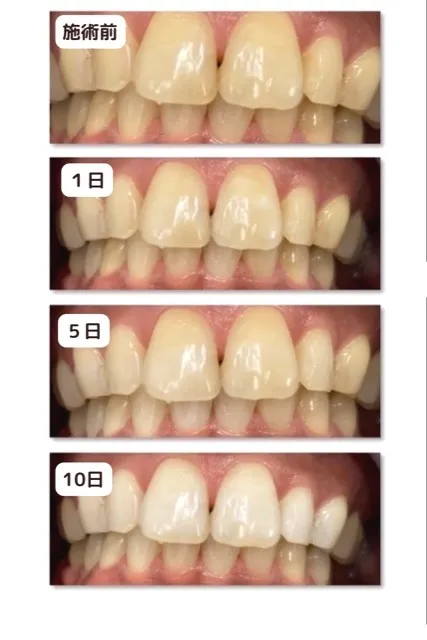 ソフトジェルホワイトニング　経過写真