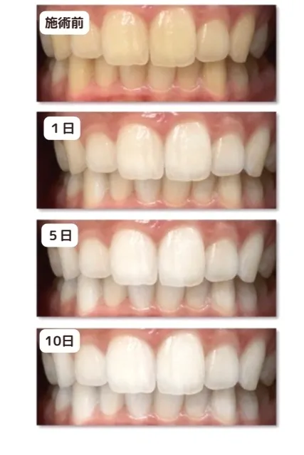 プラチナホワイトニング　経過写真