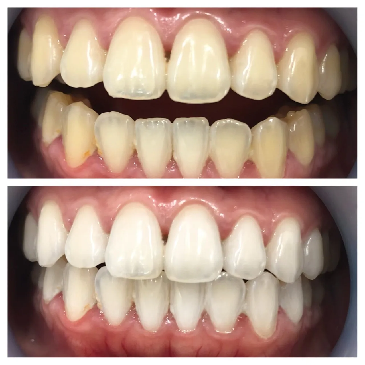 プラチナホワイトニング