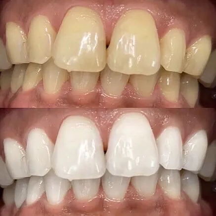 プラチナホワイトニング