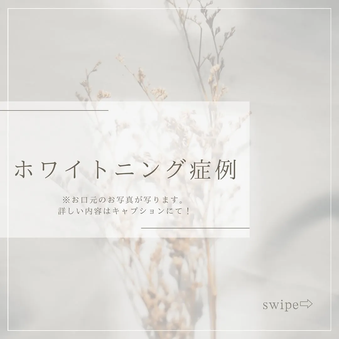 Data▼プラチナホワイトニングBefore→After