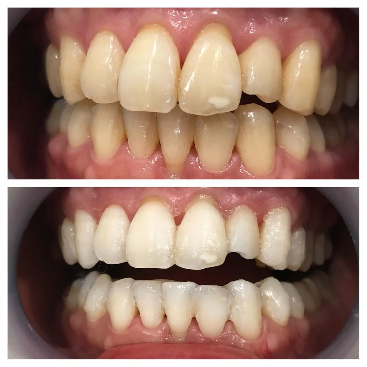 Data▼プラチナホワイトニングBefore→After