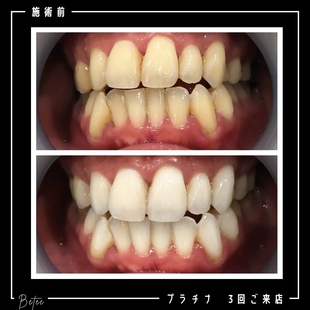 Data▼ ホワイトニング症例