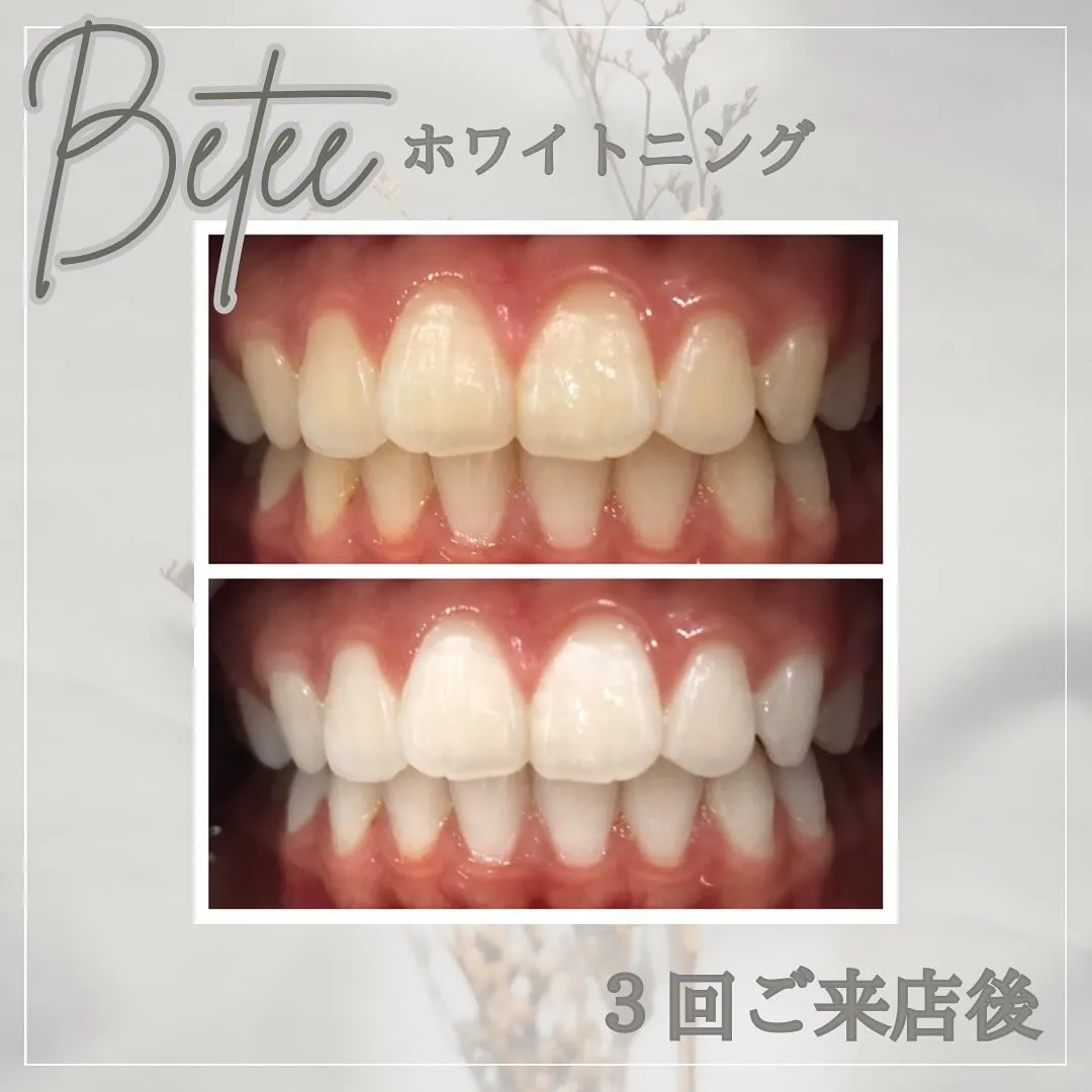 Data▼ ホワイトニングBefore→After