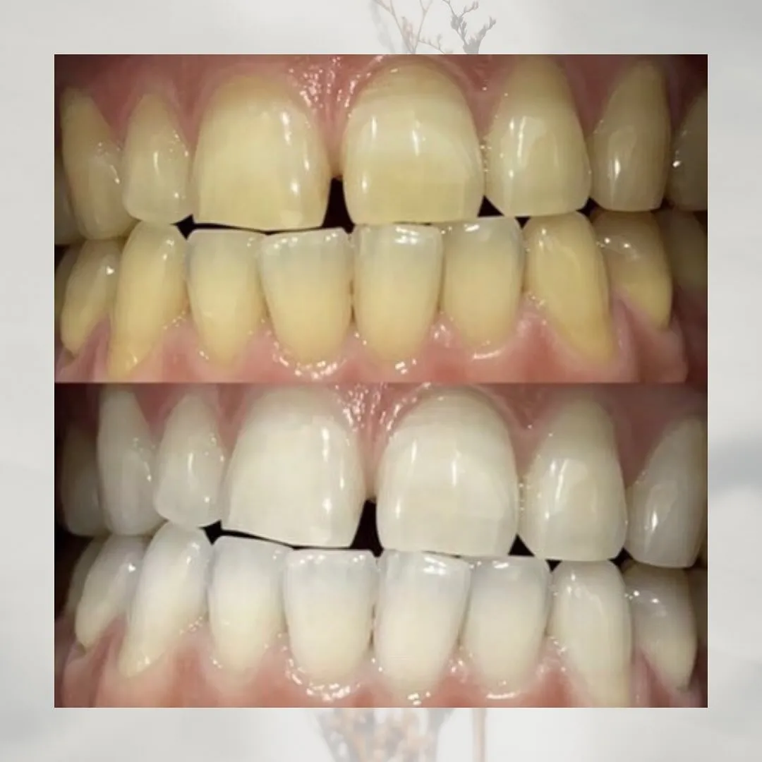 Data▼ ホワイトニングBefore→ After