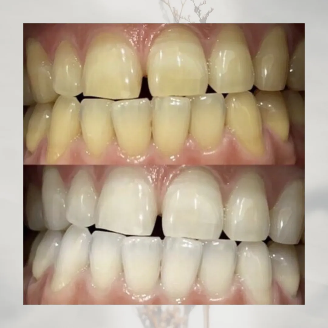 プラチナホワイトニングBefore→After
