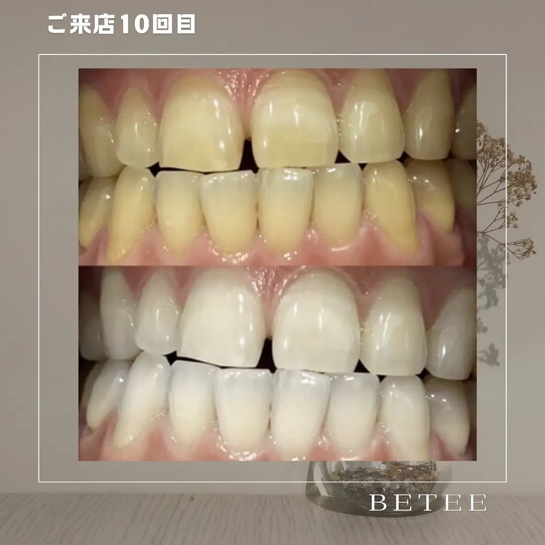 @whitening_betee