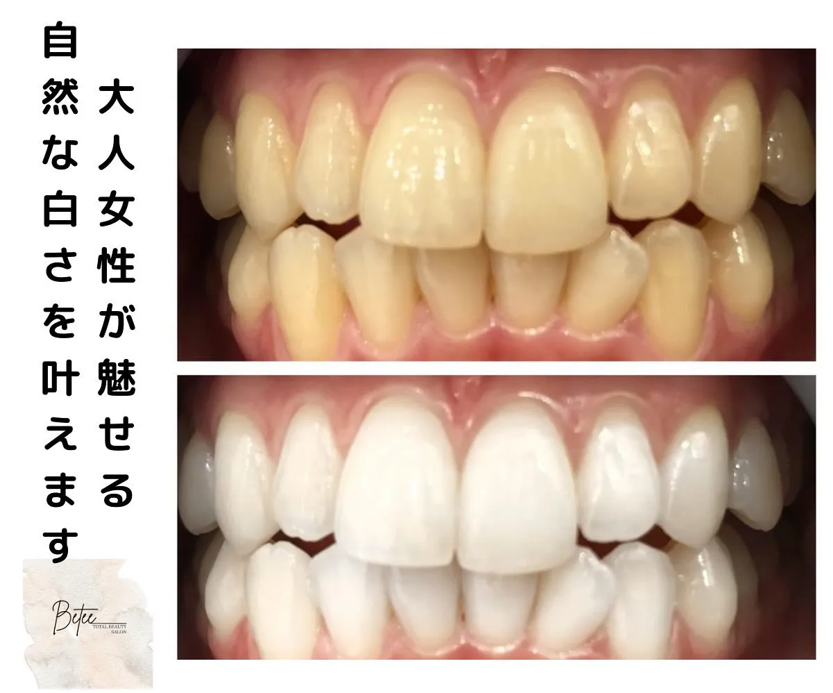 @whitening_betee