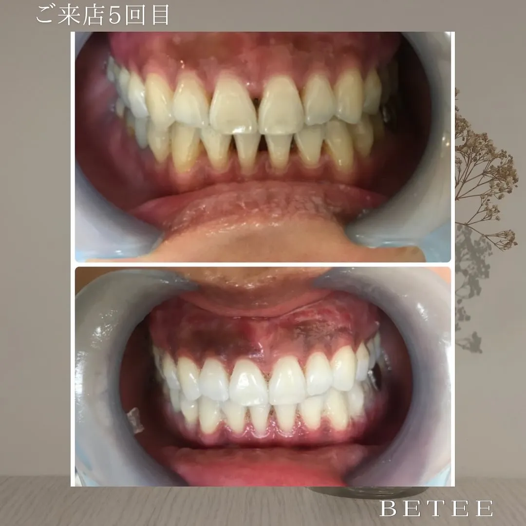 @whitening_betee