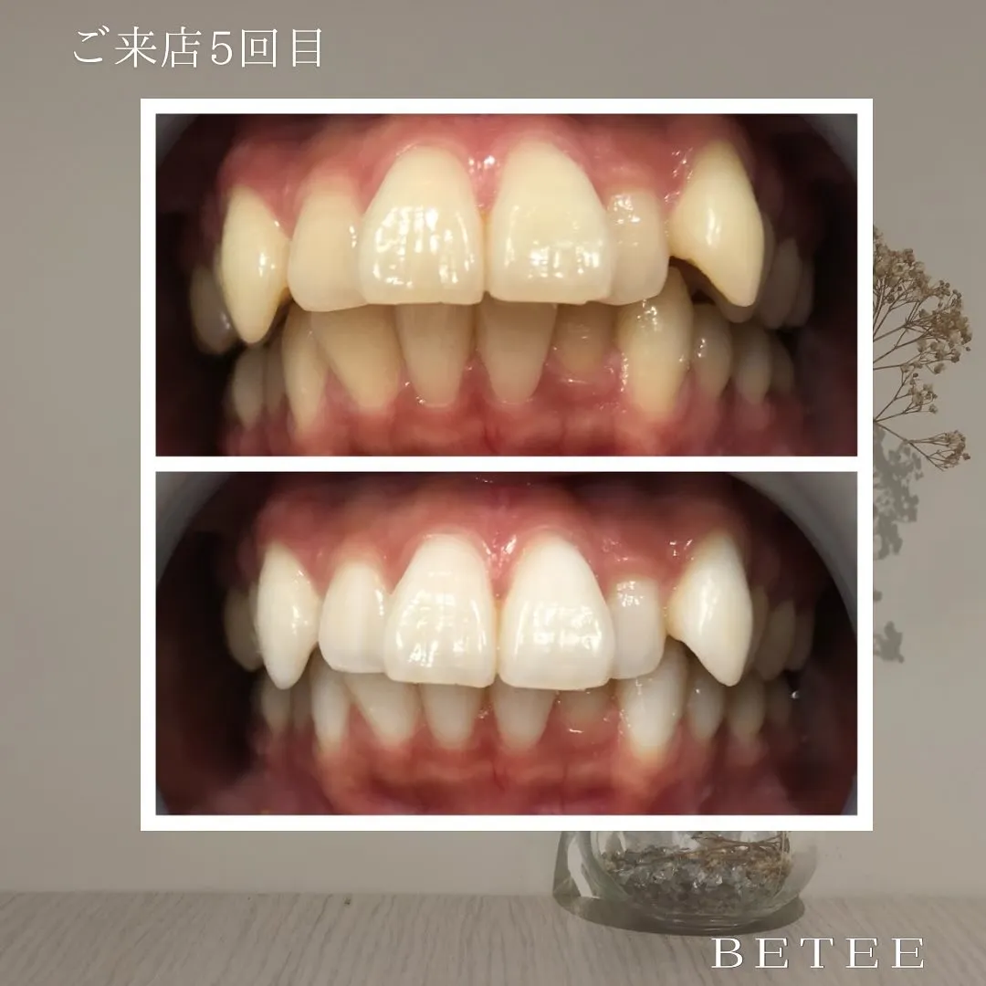 @whitening_betee
