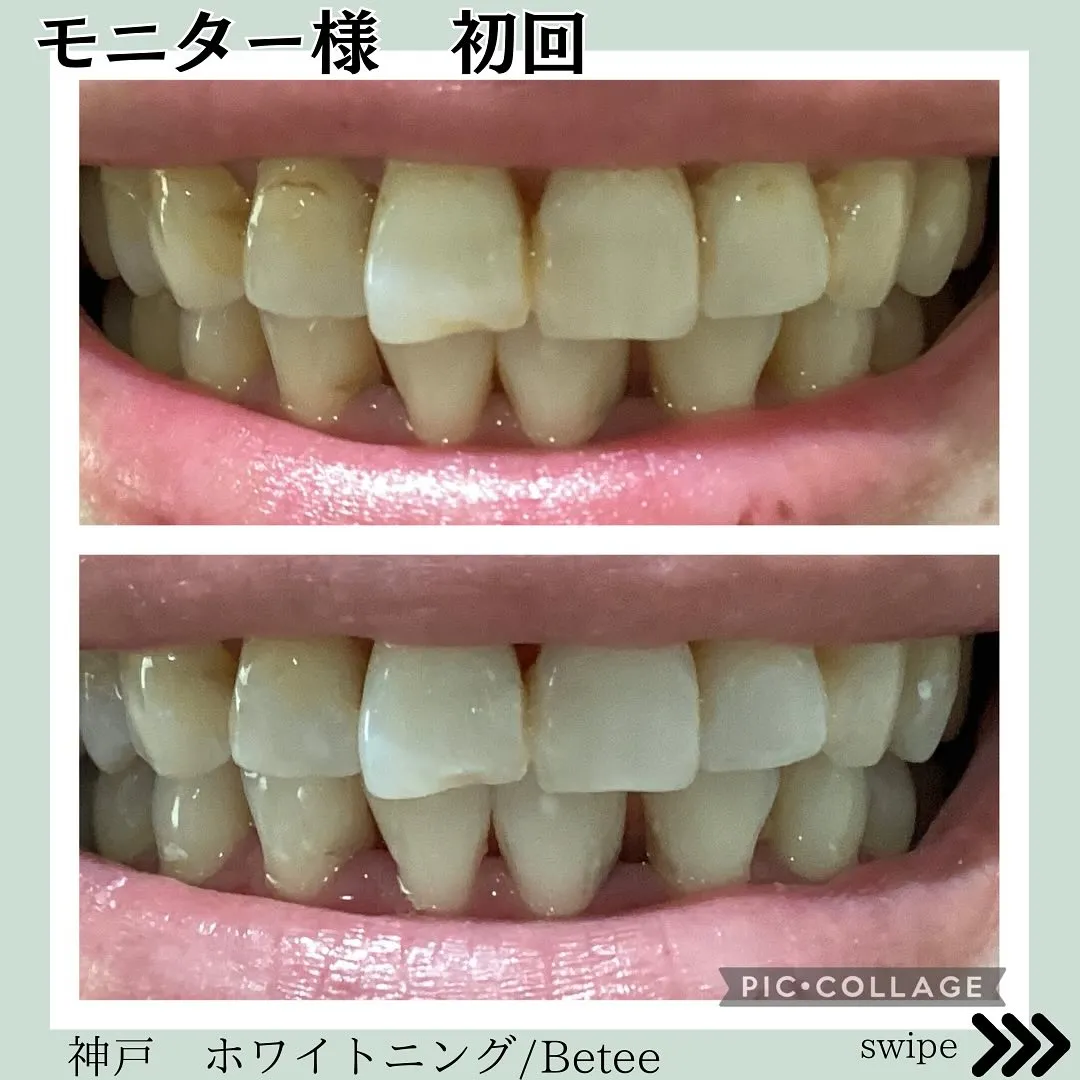 @whitening_betee ホワイトニング