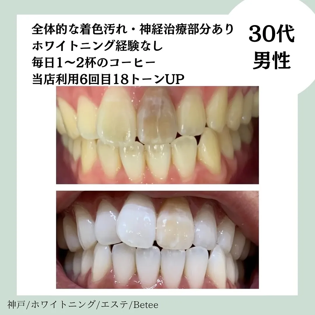 @whitening_betee ホワイトニング