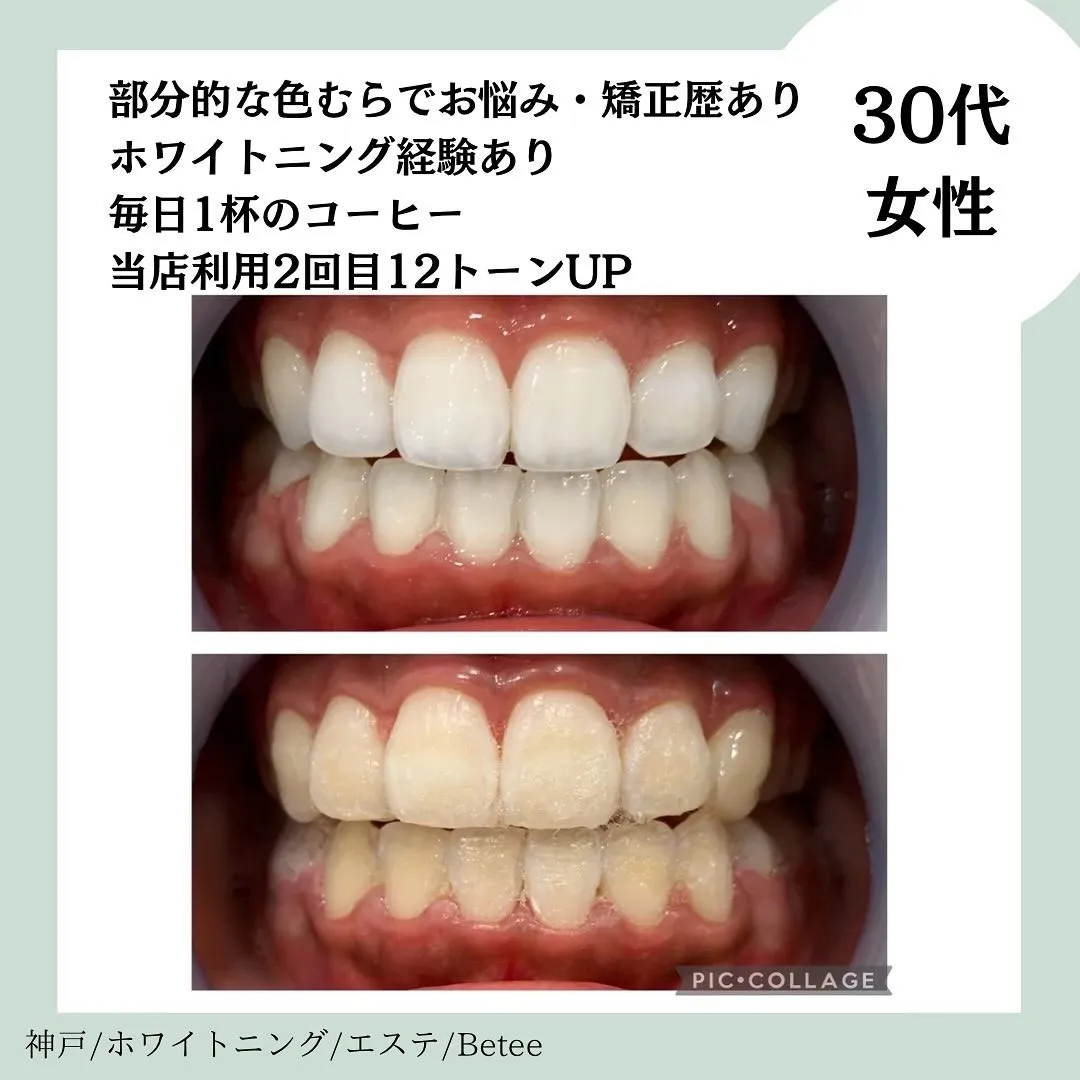 @whitening_betee ホワイトニング