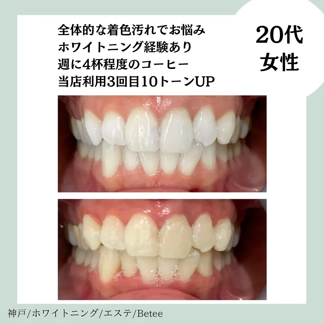 @whitening_betee ホワイトニング
