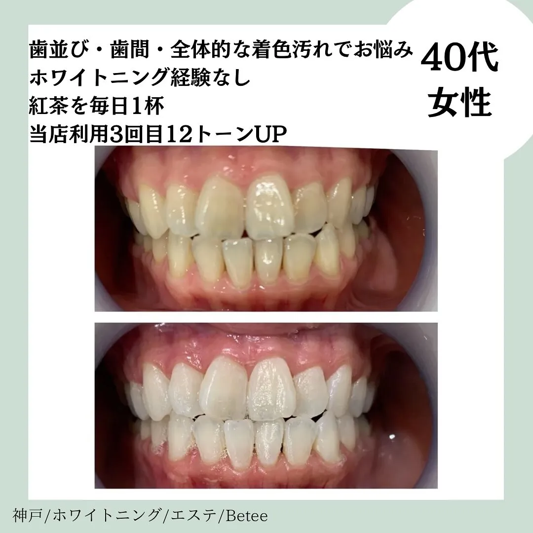 @whitening_betee ホワイトニング