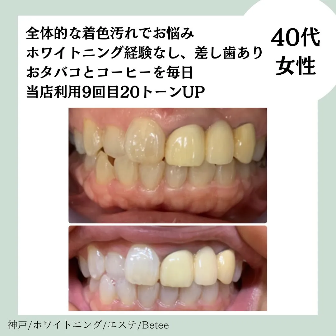 @whitening_betee ホワイトニング
