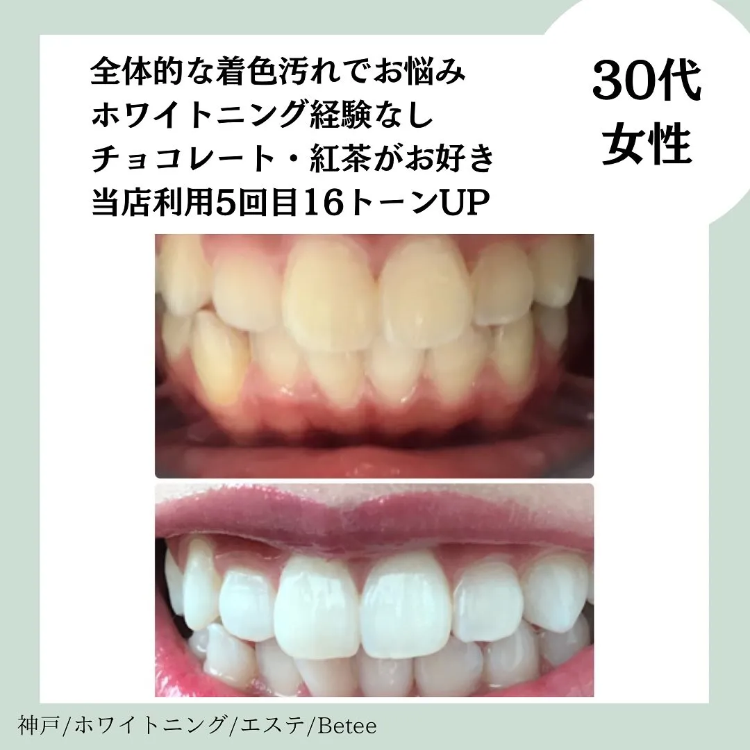 @whitening_betee ホワイトニング