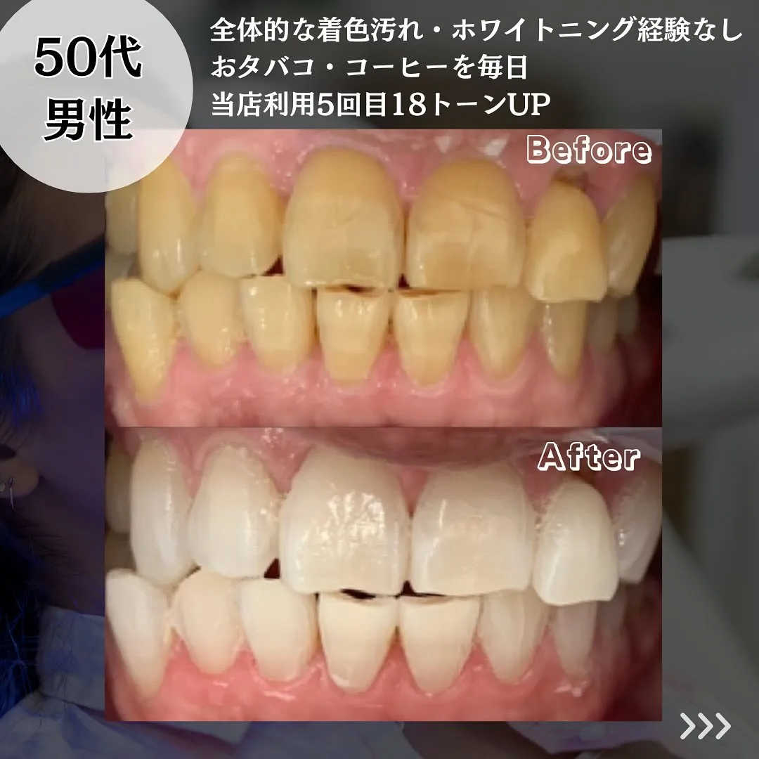 @whitening_betee ホワイトニング