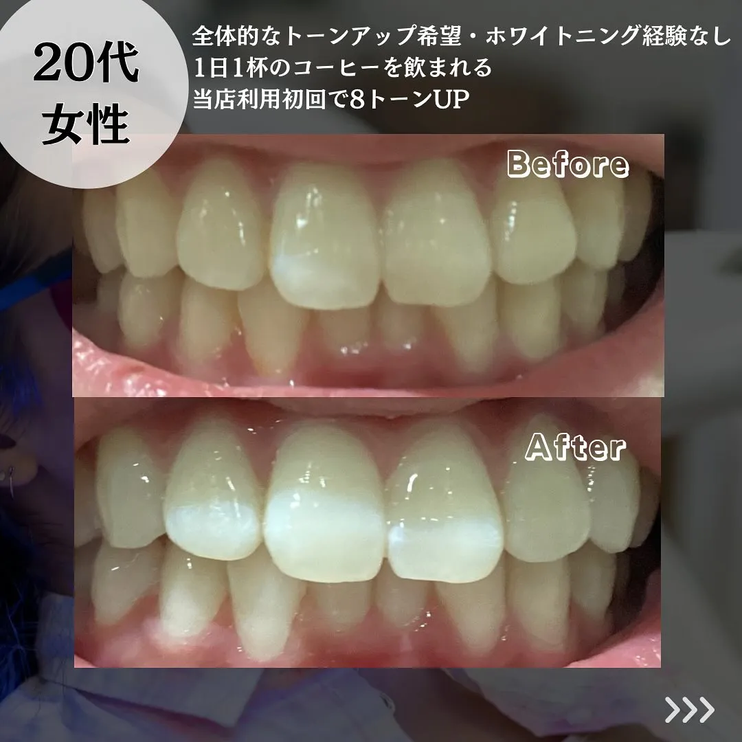 @whitening_betee ホワイトニング