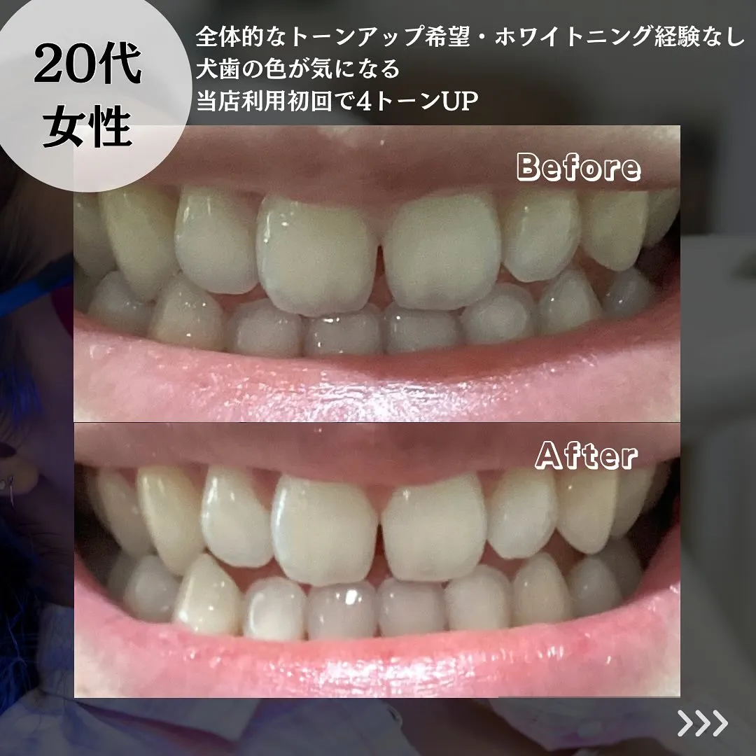@whitening_betee ホワイトニング
