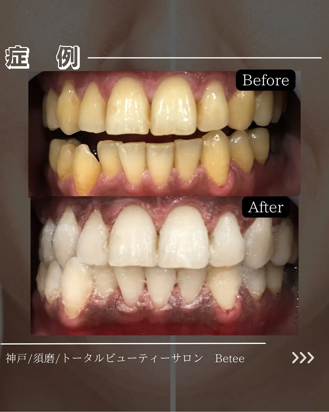 @whitening_betee ホワイトニング