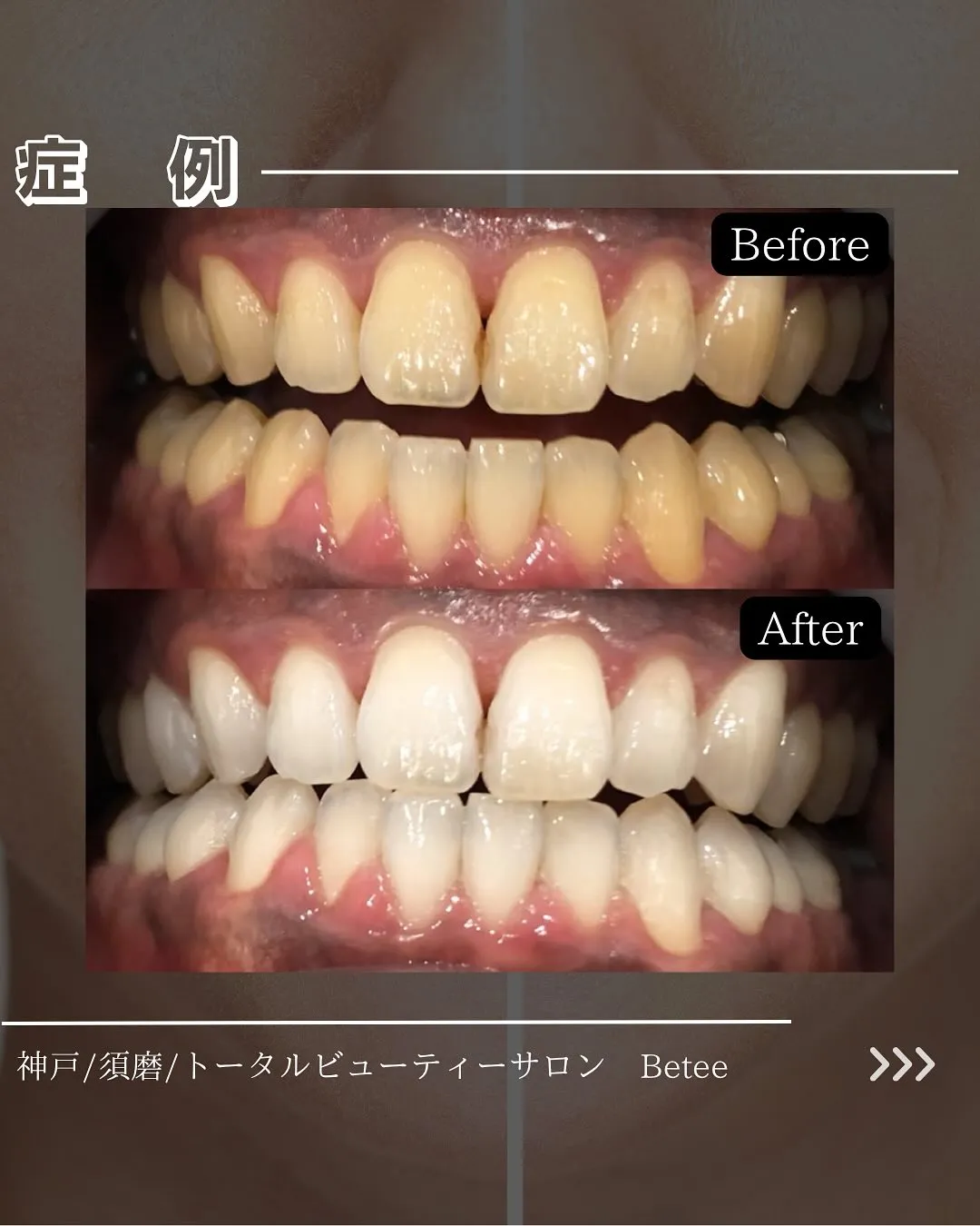 @whitening_betee ホワイトニング