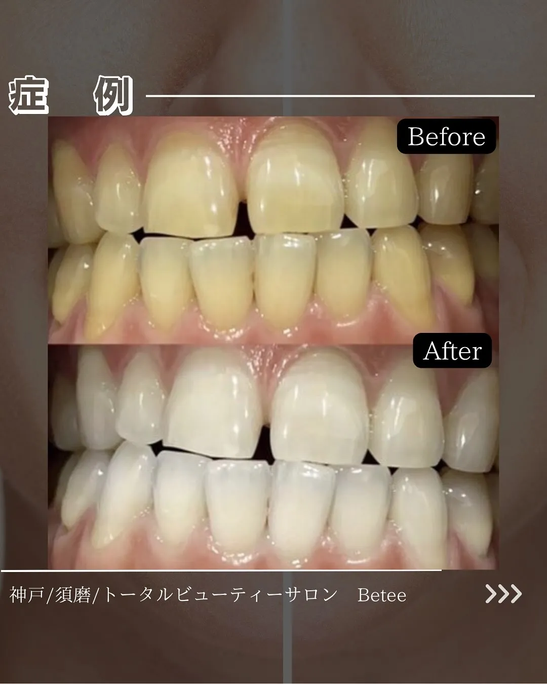 @whitening_betee ホワイトニング