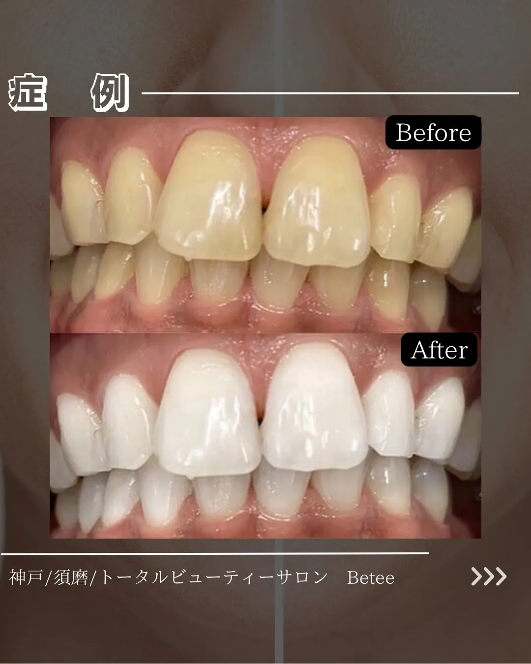 @whitening_betee ホワイトニング