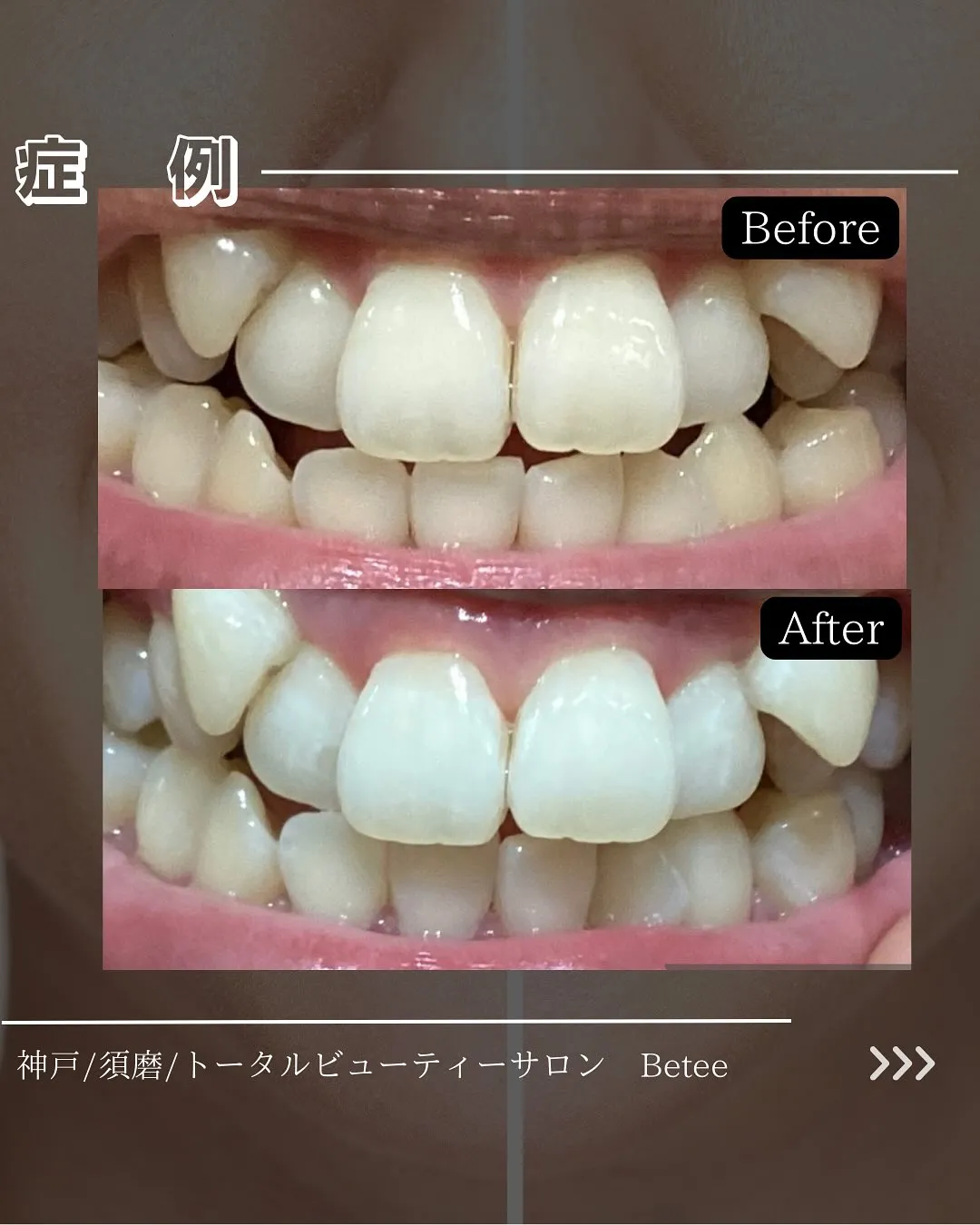 @whitening_betee ホワイトニング