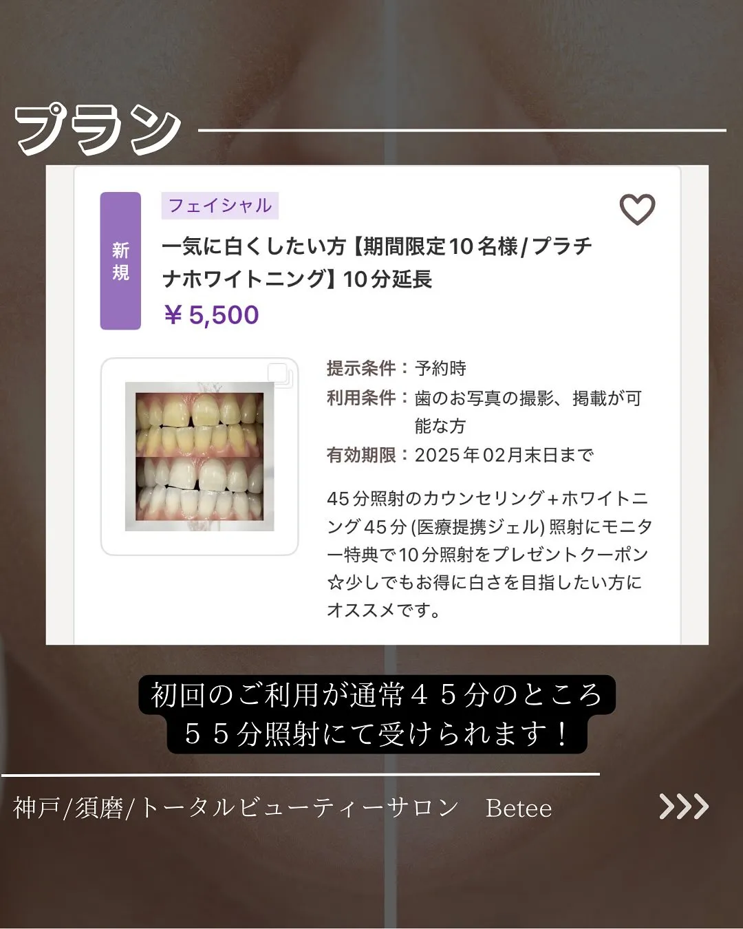 @whitening_betee ホワイトニング