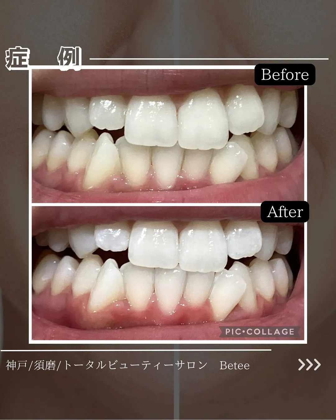 @whitening_betee 