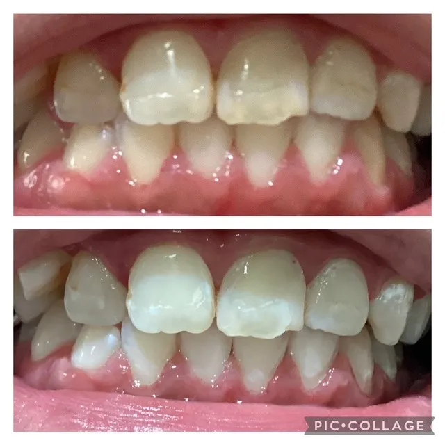 プラチナホワイトニング　初回