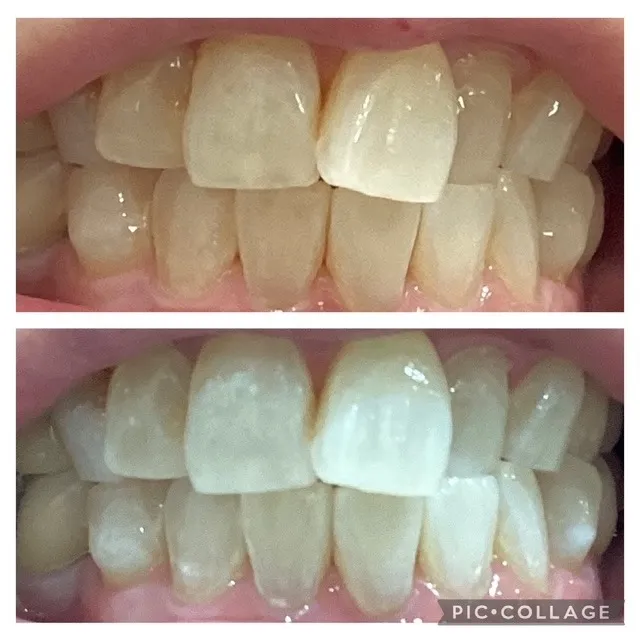 プラチナホワイトニング　初回