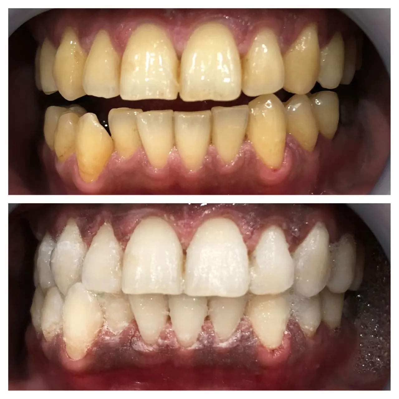 プラチナホワイトニング　１０日