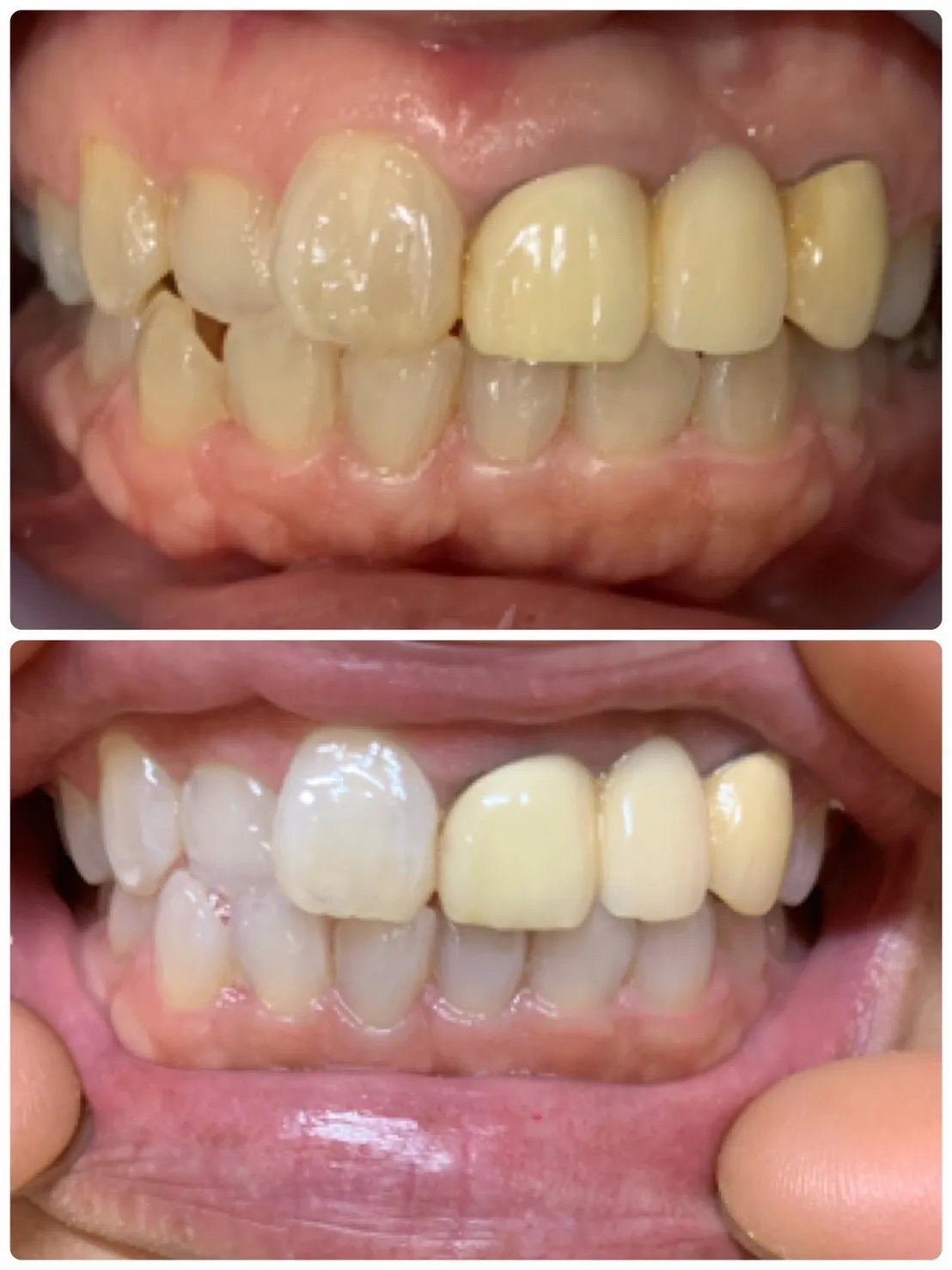 人口歯あり　プラチナホワイトニング　１０日