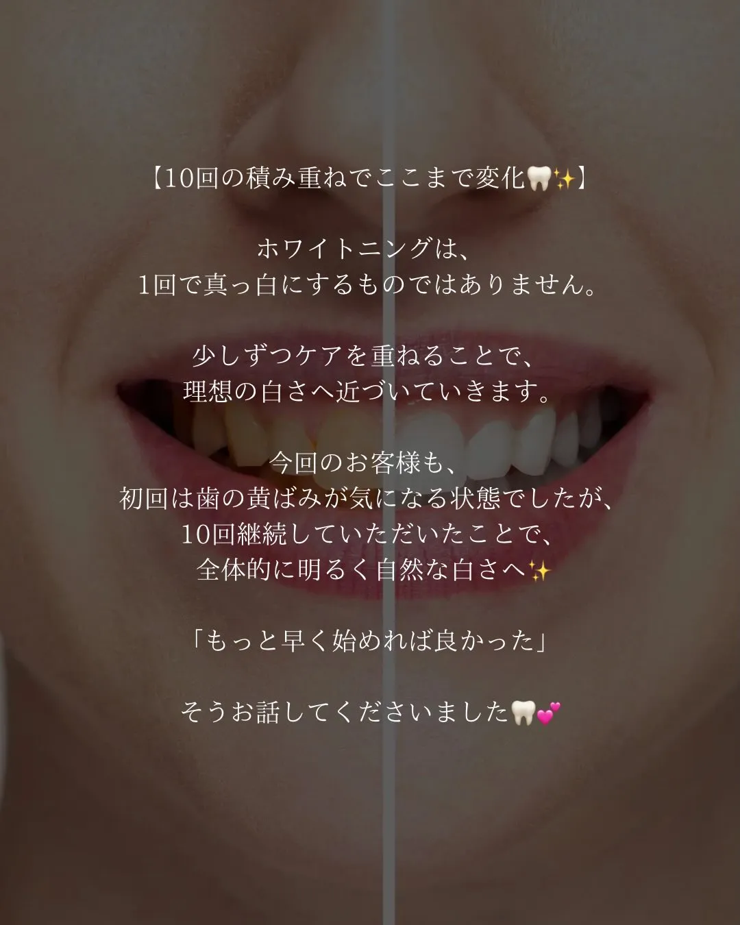 @whitening_betee
