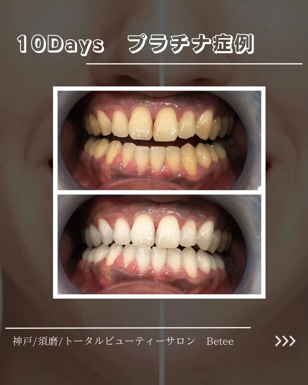 @whitening_betee