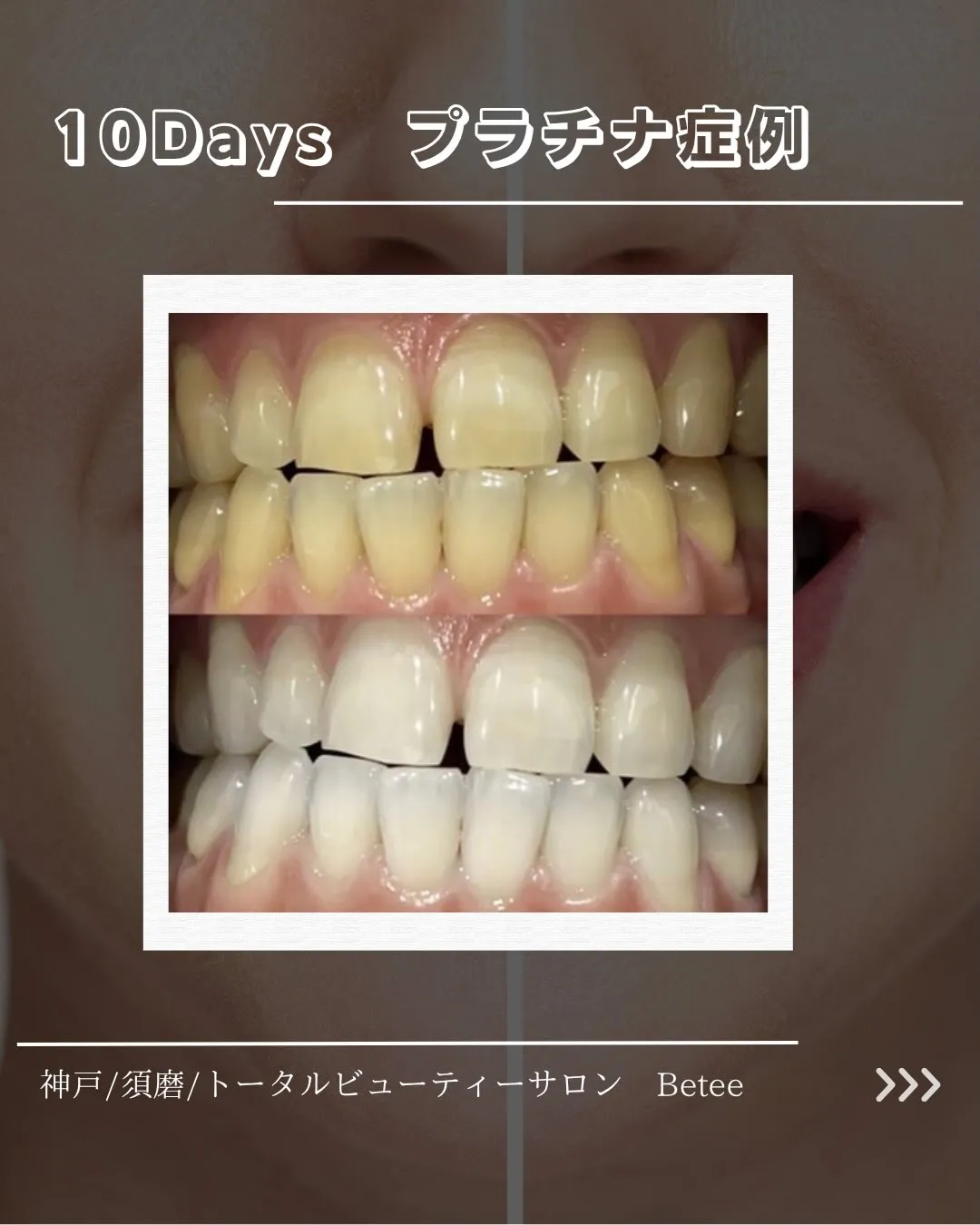 @whitening_betee 