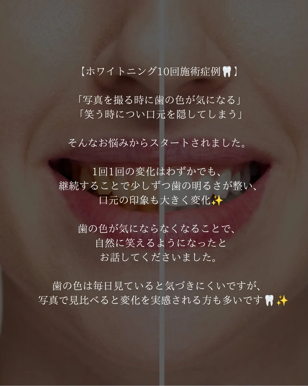 @whitening_betee